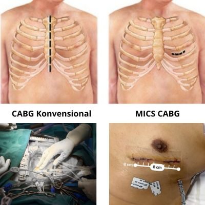 Ilustrasi Operasi Bypass Jantung Minimal Invasif MICS CABG